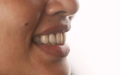 Root Canal Treatment in Kochi: Save Your Natural Tooth with Expert Care